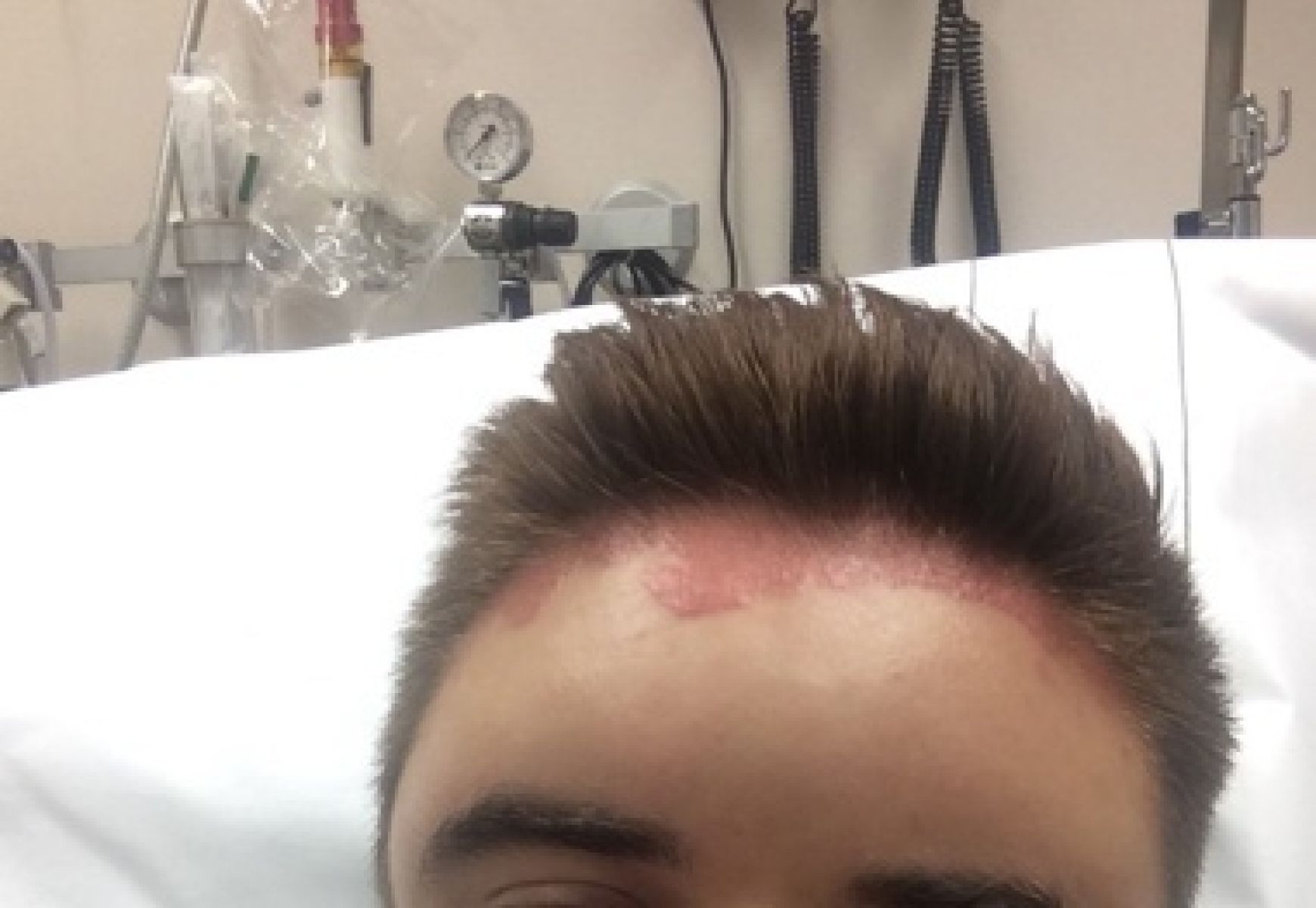 Липецкие врачи спасли подростка от сильнейшей аллергии после того, как ему покрасили волосы