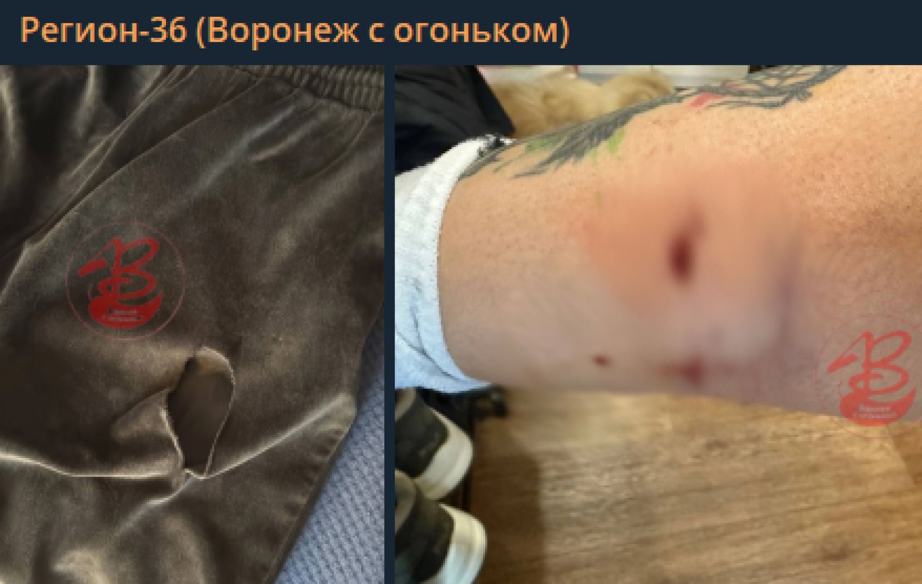 Укусы на теле девушки, на которую напали собаки на улице Ворошилова.