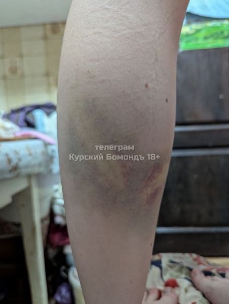 В Курске бродячая собака покусала женщину