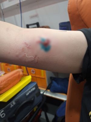 «Хозяйка спустила пса и крикнула «Фас!» Воронежец рассказал о нападении породистой собаки