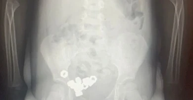 16 гаек проглотил малыш в Воронеже