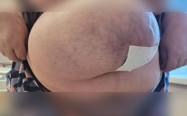 Огромную грыжу живота удалили пациентке воронежские врачи