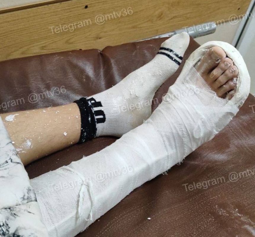 «Потерял память, а зубы только восстанавливать». Воронежцы сообщили о ребёнке, сбитом на переходе