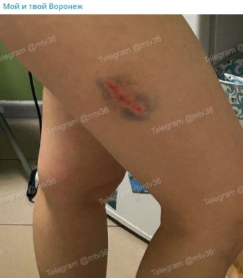 Агрессивная стая собак атаковала жительницу Воронежа