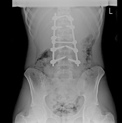 Воронежские медики поставили на ноги ребёнка, парализованного после несчастного случая