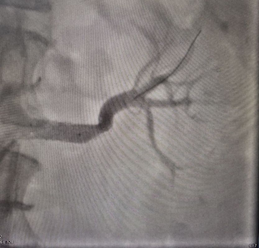 Артерия пациентки после операции