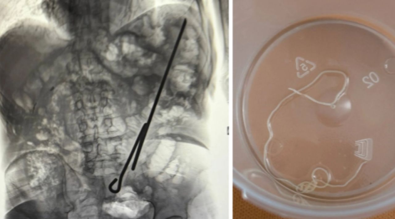 Две кошмарные находки извлекли из пациентов воронежские врачи за один день&nbsp;