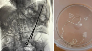Две кошмарные находки извлекли из пациентов воронежские врачи за один день 