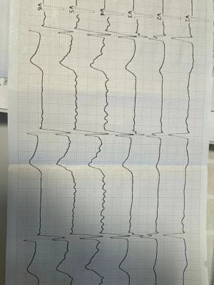 Воронежские медики спасли пациента, у которого два раза за сутки останавливалось...