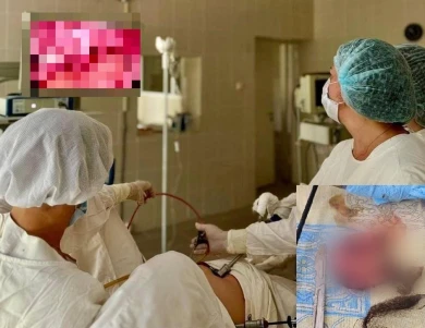 Гигантскую опухоль с волосами внутри удалили воронежанке 