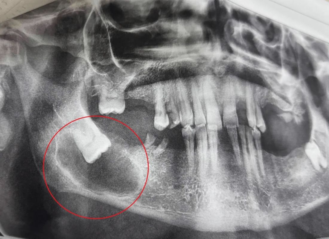 Воронежец чуть не лишился челюсти из-за зуба мудрости&nbsp;