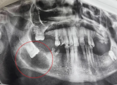 Воронежец чуть не лишился челюсти из-за зуба мудрости 