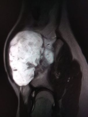 Воронежским врачам удалось спасти сустав мальчика с редкой болезнью костей