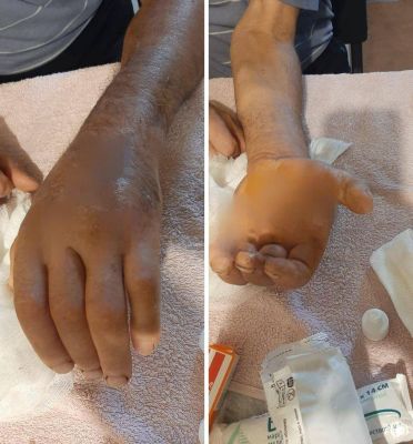 Жеребец напал на конюха в Белгородской области и заразил опасной инфекцией