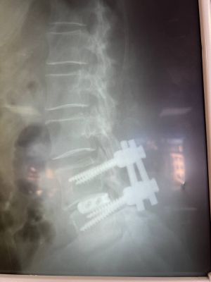 Воронежанка не могла ходить из-за адских болей в ногах, пришлось вмешаться медик...