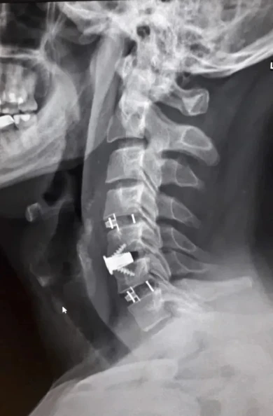 Титановые конструкции избавили воронежца от адских болей в костях