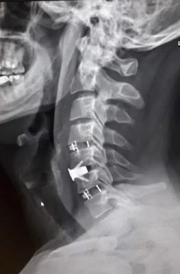 Титановые конструкции избавили воронежца от адских болей в костях