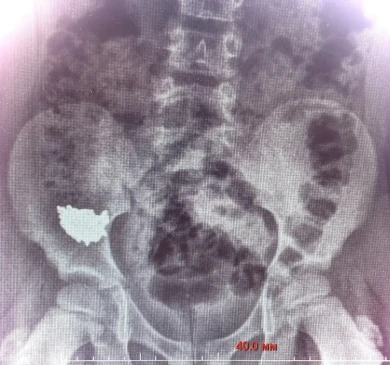 20-сантиметровую цепочку проглотил маленький воронежец