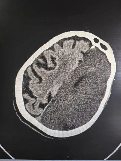 Воронежанка смогла снова двигаться после сосудистой катастрофы