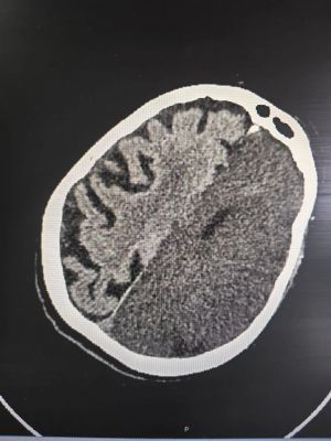 Воронежанка смогла снова двигаться после сосудистой катастрофы