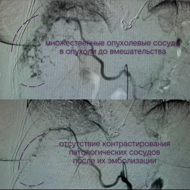 Пациентку с гигантской опухолью в печени спасли воронежские врачи