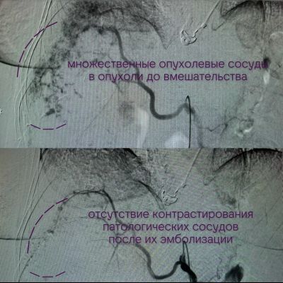 Пациентку с гигантской опухолью в печени спасли воронежские врачи