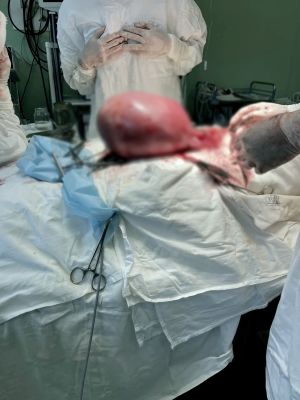 Молодая воронежанка игнорировала опухоль размером с 28-недельную беременность
