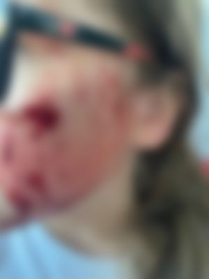 Лицо в крови. Ребёнок на электросамокате сбил девочку в Воронеже