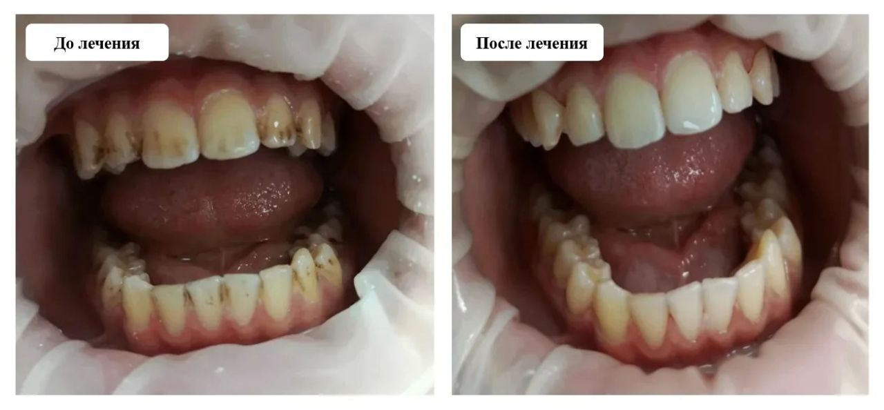 Зубы внезапно почернели у воронежского школьника